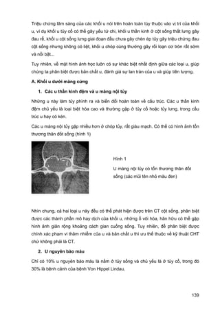 Triệu chứng lâm sàng của các khối u nói trên hoàn toàn tùy thuộc vào vị trí của khối
u, ví dụ khối u tủy cổ có thể gây yếu tứ chi, khối u thần kinh ở cột sống thắt lưng gây
đau rễ, khối u cột sống lưng giai đoạn đầu chưa gây chèn ép tủy gây triệu chứng đau
cột sống nhưng không có liệt, khối u chóp cùng thường gây rối loạn cơ tròn rất sớm
và nổi bật...
Tuy nhiên, về mặt hình ảnh học luôn có sự khác biệt nhất định giữa các loại u, giúp
chúng ta phân biệt được bản chất u, đánh giá sự lan tràn của u và giúp tiên lượng.
A. Khối u dưới màng cứng
1. Các u thần kinh đệm và u màng nội tủy
Những u này làm tủy phình ra và biến đổi hoàn toàn về cấu trúc. Các u thần kinh
đệm chủ yếu là loại biệt hóa cao và thường gặp ở tủy cổ hoặc tủy lưng, trong cấu
trúc u hay có kén.
Các u màng nội tủy gặp nhiều hơn ở chóp tủy, rất giàu mạch. Có thể có hình ảnh tổn
thương thân đốt sống (hình 1)

Hình 1
U màng nội tủy có tổn thương thân đốt
sống (các mũi tên nhỏ màu đen)

Nhìn chung, cả hai loại u này đều có thể phát hiện được trên CT cột sống, phân biệt
được các thành phần mô hay dịch của khối u, những ổ vôi hóa, hãn hữu có thể gặp
hình ảnh giãn rộng khoảng cách gian cuống sống. Tuy nhiên, để phân biệt được
chính xác phạm vi thâm nhiễm của u và bản chất u thì ưu thế thuộc về kỹ thuật CHT
chứ không phải là CT.
2. U nguyên bào máu
Chỉ có 10% u nguyên bào máu là nằm ở tủy sống và chủ yếu là ở tủy cổ, trong đó
30% là bệnh cảnh của bệnh Von Hippel Lindau.

139

 