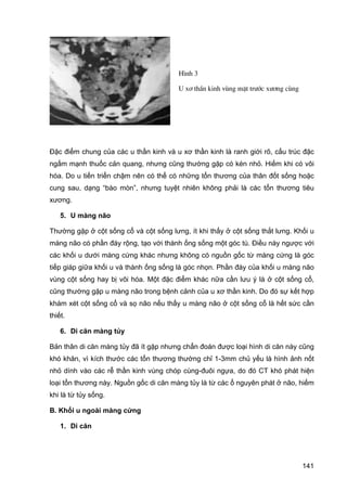 H×nh 3
U x¬ thÇn kinh vïng mÆt tr−íc x−¬ng cïng

Đặc điểm chung của các u thần kinh và u xơ thần kinh là ranh giới rõ, cấu trúc đặc
ngấm mạnh thuốc cản quang, nhưng cũng thường gặp có kén nhỏ. Hiếm khi có vôi
hóa. Do u tiến triển chậm nên có thể có những tổn thương của thân đốt sống hoặc
cung sau, dạng “bào mòn”, nhưng tuyệt nhiên không phải là các tổn thương tiêu
xương.
5. U màng não
Thường gặp ở cột sống cổ và cột sống lưng, ít khi thấy ở cột sống thắt lưng. Khối u
màng não có phần đáy rộng, tạo với thành ống sống một góc tù. Điều này ngược với
các khối u dưới màng cứng khác nhưng không có nguồn gốc từ màng cứng là góc
tiếp giáp giữa khối u và thành ống sống là góc nhọn. Phần đáy của khối u màng não
vùng cột sống hay bị vôi hóa. Một đặc điểm khác nữa cần lưu ý là ở cột sống cổ,
cũng thường gặp u màng não trong bệnh cảnh của u xơ thần kinh. Do đó sự kết hợp
khám xét cột sống cổ và sọ não nếu thấy u màng não ở cột sống cổ là hết sức cần
thiết.
6. Di căn màng tủy
Bản thân di căn màng tủy đã ít gặp nhưng chẩn đoán được loại hình di căn này cũng
khó khăn, vì kích thước các tổn thương thường chỉ 1-3mm chủ yếu là hình ảnh nốt
nhỏ dính vào các rễ thần kinh vùng chóp cùng-đuôi ngựa, do đó CT khó phát hiện
loại tổn thương này. Nguồn gốc di căn màng tủy là từ các ổ nguyên phát ở não, hiếm
khi là từ tủy sống.
B. Khối u ngoài màng cứng
1. Di căn

141

 