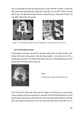 này, vỏ xương đặc của thân đốt sống bị phá vỡ, khối u xâm lấn ra phạm vi quanh cột
sống hoặc trong lòng ống sống, đồng thời trong cấu trúc của khối u thấy có những
đám tổ chức mô đặc nằm xen giữa các bè xương chạy dọc, những đám tổ chức mô
này ngấm mạnh thuốc cản quang.

H×nh 5. U m¹ch th©n ®èt sèng víi c¸c bÌ x−¬ng ®Æc (1), tæ chøc m« (2) vµ mì (3)

2.2. U xương dạng xương
Thường gặp ở nam giới, tuổi dưới 40, trên lâm sàng có đau cột sống về đêm, mức
độ đau khá mạnh nhưng giảm rõ rệt nếu dùng aspirine. Tuy nhiên, chỉ có 10% u
xương dạng xương là ở cột sống, trong đó 60% khu trú ở cột sống thắt lưng và 75%
trường hợp tổn thương nằm ở cung sau.

H×nh 6
U x−¬ng d¹ng x−¬ng víi nh©n trung t©m

Trên hình ảnh CT (bắt buộc phải chụp lớp mỏng), tổn thương của u xương dạng
xương có dạng một vùng xương đặc có trung tâm là một ổ khuyết thường bị vôi hóa
(gọi là nhân trung tâm hay nidus) (hình 6). Trừ trường hợp không thể chọc sinh thiết
được do không có đường vào, còn thì nên chọc sinh thiết dưới hướng dẫn của CT,

144

 