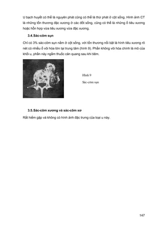 U bạch huyết có thể là nguyên phát cũng có thể là thứ phát ở cột sống. Hình ảnh CT
là những tổn thương đặc xương ở các đốt sống, cũng có thể là những ổ tiêu xương
hoặc hỗn hợp vừa tiêu xương vừa đặc xương.
3.4. Sác-côm sụn
Chỉ có 3% sác-côm sụn nằm ở cột sống, với tổn thương nổi bật là hình tiêu xương rõ
nét có nhiều ổ vôi hóa lớn tại trung tâm (hình 9). Phần không vôi hóa chính là mô của
khối u, phần này ngấm thuốc cản quang sau khi tiêm.

H×nh 9
S¸c-c«m sôn

3.5. Sác-côm xương và sác-côm xơ
Rất hiếm gặp và không có hình ảnh đặc trưng của loại u này.

147

 