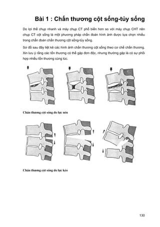 Bài 1 : Chấn thương cột sống-tủy sống
Do lợi thế chụp nhanh và máy chụp CT phổ biến hơn so với máy chụp CHT nên
chụp CT cột sống là một phương pháp chẩn đoán hình ảnh được lựa chọn nhiều
trong chẩn đoán chấn thương cột sống-tủy sống.
Sơ đồ sau đây liệt kê các hình ảnh chấn thương cột sống theo cơ chế chấn thương.
Xin lưu ý rằng các tổn thương có thể gặp đơn độc, nhưng thường gặp là có sự phối
hợp nhiều tổn thương cùng lúc.

ChÊn th−¬ng cét sèng do lùc nÐn

ChÊn th−¬ng cét sèng do lùc kÐo

130

 