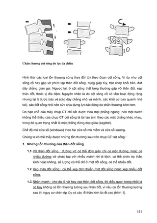 ChÊn th−¬ng cét sèng do lùc ®a chiÒu

Hình thái các loại tổn thương cũng thay đổi tùy theo đoạn cột sống. Ví dụ như cột
sống cổ hay gặp vỡ phức tạp thân đốt sống, đụng giập tủy, trật khớp khối bên, đứt
dây chằng gian gai. Ngược lại, ở cột sống thắt lưng thường gặp vỡ thân đốt, xẹp
thân đốt, thoát vị đĩa đệm. Nguyên nhân là do cột sống cổ có tầm hoạt động rộng
nhưng lại ít được bảo vệ (các dây chằng nhỏ và mảnh, các khối cơ bao quanh nhỏ
bé), các đốt sống nhỏ nên sức chịu đựng lực tác động do chấn thương kém hơn.
Do hạn chế của máy chụp CT chỉ cắt đuợc theo mặt phẳng ngang, nên một bước
không thể thiếu của chụp CT cột sống là tái tạo ảnh theo các mặt phẳng khác nhau,
trong đó quan trọng nhất là mặt phẳng đứng dọc giữa (sagittal).
Chế độ mở cửa sổ (windows) theo hai cửa sổ mô mềm và cửa sổ xương.
Chúng ta có thể thấy được những tổn thương sau trên chụp CT cột sống :
1. Những tổn thương của thân đốt sống
1.1. Vỡ thân đốt sống : đường vỡ có thể đơn giản chỉ có một đường, hoặc có
nhiều đường vỡ phức tạp với nhiều mảnh rời di lệch, có thể chèn ép thần
kinh hoặc không, số lượng có thể chỉ ở một đốt sống, có thể nhiều đốt.
1.2. Xẹp thân đốt sống : có thể xẹp đơn thuần một đốt sống hoặc xẹp nhiều đốt
sống.
1.3. Nhấn mạnh : cho dù là vỡ hay xẹp thân đốt sống, thì điều quan trọng nhất là
có hay không có tổn thương tường sau thân đốt, vì nếu có tổn thương tường
sau thì nguy cơ chèn ép tủy và các rễ thần kinh là rất cao (hình 1).

131

 