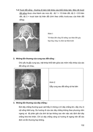 1.4. Trượt đốt sống : thường đi kèm trật khớp của khối khớp bên. Mức độ trượt
đốt sống được chia thành các mức độ : độ 1 = 1/3 thân đốt, độ 2 = 2/3 thân
đốt, độ 3 = trượt toàn bộ thân đốt (tính theo chiều trước-sau của thân đốt
sống).

H×nh 1
Vì th©n ®èt sèng låi t−êng sau th©n ®èt g©y
hÑp èng sèng vµ chÌn Ðp thÇn kinh

2. Những tổn thương của cung sau đốt sống :
Chủ yếu là gẫy cung sau, trật khớp khối bên giữa các mỏm mấu khớp của các
đốt sống với nhau.

Hình 2
Gẫy cung sau đốt sống cả hai bên

3. Những tổn thương của dây chằng :
Đứt dây chằng thường quan sát thấy ở những vị trí dây chằng lớn, dầy như ở
cột sống thắt lưng. Do hướng đi của các dây chằng không theo phương nằm
ngang và độ phân giải của ảnh tái tạo không cao nên việc xác định đứt dây
chằng khá khó khăn. Chỉ có dây chằng vàng có hướng đi ngang nên dễ xác
định có tổn thương hay không.
132

 