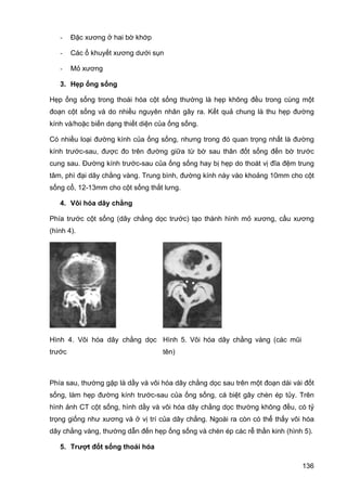 -

Đặc xương ở hai bờ khớp

-

Các ổ khuyết xương dưới sụn

-

Mỏ xương

3. Hẹp ống sống
Hẹp ống sống trong thoái hóa cột sống thường là hẹp không đều trong cùng một
đoạn cột sống và do nhiều nguyên nhân gây ra. Kết quả chung là thu hẹp đường
kính và/hoặc biến dạng thiết diện của ống sống.
Có nhiều loại đường kính của ống sống, nhưng trong đó quan trọng nhất là đường
kính trước-sau, được đo trên đường giữa từ bờ sau thân đốt sống đến bờ trước
cung sau. Đường kính trước-sau của ống sống hay bị hẹp do thoát vị đĩa đệm trung
tâm, phì đại dây chằng vàng. Trung bình, đường kính này vào khoảng 10mm cho cột
sống cổ, 12-13mm cho cột sống thắt lưng.
4. Vôi hóa dây chằng
Phía trước cột sống (dây chằng dọc trước) tạo thành hình mỏ xương, cầu xương
(hình 4).

Hình 4. Vôi hóa dây chằng dọc Hình 5. Vôi hóa dây chằng vàng (các mũi
trước

tên)

Phía sau, thường gặp là dầy và vôi hóa dây chằng dọc sau trên một đoạn dài vài đốt
sống, làm hẹp đường kính trước-sau của ống sống, cá biệt gây chèn ép tủy. Trên
hình ảnh CT cột sống, hình dầy và vôi hóa dây chằng dọc thường không đều, có tỷ
trọng giống như xương và ở vị trí của dây chằng. Ngoài ra còn có thể thấy vôi hóa
dây chằng vàng, thường dẫn đến hẹp ống sống và chèn ép các rễ thần kinh (hình 5).
5. Trượt đốt sống thoái hóa
136

 