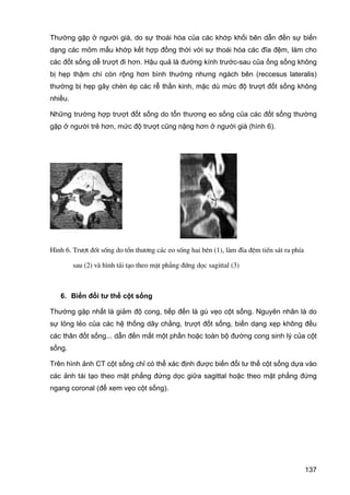 Thường gặp ở người già, do sự thoái hóa của các khớp khối bên dẫn đến sự biến
dạng các mỏm mấu khớp kết hợp đồng thời với sự thoái hóa các đĩa đệm, làm cho
các đốt sống dễ trượt đi hơn. Hậu quả là đường kính trước-sau của ống sống không
bị hẹp thậm chí còn rộng hơn bình thường nhưng ngách bên (reccesus lateralis)
thường bị hẹp gây chèn ép các rễ thần kinh, mặc dù mức độ trượt đốt sống không
nhiều.
Những trường hợp trượt đốt sống do tổn thương eo sống của các đốt sống thường
gặp ở người trẻ hơn, mức độ trượt cũng nặng hơn ở người già (hình 6).

H×nh 6. Tr−ît ®èt sèng do tæn th−¬ng c¸c eo sèng hai bªn (1), lµm ®Üa ®Öm tiÕn s¸t ra phÝa
sau (2) vµ h×nh t¸i t¹o theo mÆt ph¼ng ®øng däc sagittal (3)

6. Biến đổi tư thế cột sống
Thường gặp nhất là giảm độ cong, tiếp đến là gù vẹo cột sống. Nguyên nhân là do
sự lỏng lẻo của các hệ thống dây chằng, trượt đốt sống, biến dạng xẹp không đều
các thân đốt sống... dẫn đến mất một phần hoặc toàn bộ đường cong sinh lý của cột
sống.
Trên hình ảnh CT cột sống chỉ có thể xác định được biến đổi tư thế cột sống dựa vào
các ảnh tái tạo theo mặt phẳng đứng dọc giữa sagittal hoặc theo mặt phẳng đứng
ngang coronal (để xem vẹo cột sống).

137

 