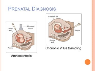 PRENATAL DIAGNOSIS
Amniocentesis
Chorionic Villus Sampling
 