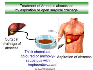 Dr. RAAFAT MOHAMED
Treatment of Amoebic abscesses
by aspiration or open surgical drainage
Aspiration of abscess
Surgical
drainage of
abscess
Thick chocolate-
coloured or anchovy-
sauce pus with
trophozoites
Dr. RAAFAT MOHAMED
 
