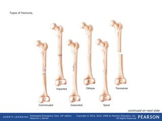 Prehospital Emergency Care, 10th
edition
Mistovich | Karren
Copyright © 2014, 2010, 2008 by Pearson Education, Inc.
All Rights Reserved
Types of fractures.
continued on next slide
 