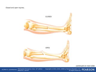 Prehospital Emergency Care, 10th
edition
Mistovich | Karren
Copyright © 2014, 2010, 2008 by Pearson Education, Inc.
All Rights Reserved
Closed and open injuries.
continued on next slide
 