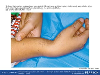 Prehospital Emergency Care, 10th
edition
Mistovich | Karren
Copyright © 2014, 2010, 2008 by Pearson Education, Inc.
All Rights Reserved
A closed fracture has no associated open wound. (Shown here, a Colles fracture to the wrist, also called a silver
fork deformity because the deformed wrist looks like an inverted fork.)
(© Charles Stewart, MD, FACEP)
continued on next slide
 