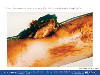 Prehospital Emergency Care, 10th
edition
Mistovich | Karren
Copyright © 2014, 2010, 2008 by Pearson Education, Inc.
All Rights Reserved
An open fracture presents with an open wound, often with a bone end protruding through the skin.
continued on next slide
 