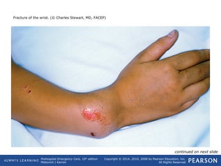 Prehospital Emergency Care, 10th
edition
Mistovich | Karren
Copyright © 2014, 2010, 2008 by Pearson Education, Inc.
All Rights Reserved
Fracture of the wrist. (© Charles Stewart, MD, FACEP)
continued on next slide
 