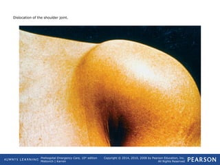 Prehospital Emergency Care, 10th
edition
Mistovich | Karren
Copyright © 2014, 2010, 2008 by Pearson Education, Inc.
All Rights Reserved
Dislocation of the shoulder joint.
 
