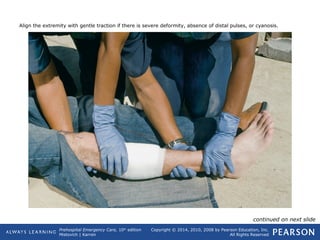 Prehospital Emergency Care, 10th
edition
Mistovich | Karren
Copyright © 2014, 2010, 2008 by Pearson Education, Inc.
All Rights Reserved
Align the extremity with gentle traction if there is severe deformity, absence of distal pulses, or cyanosis.
continued on next slide
 
