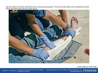 Prehospital Emergency Care, 10th
edition
Mistovich | Karren
Copyright © 2014, 2010, 2008 by Pearson Education, Inc.
All Rights Reserved
Pad the splint to prevent discomfort and unnecessary pressure. The correct size splint will immobilize the joint
above and below the site of a bone injury.
continued on next slide
 