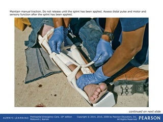 Prehospital Emergency Care, 10th
edition
Mistovich | Karren
Copyright © 2014, 2010, 2008 by Pearson Education, Inc.
All Rights Reserved
Maintain manual traction. Do not release until the splint has been applied. Assess distal pulse and motor and
sensory function after the splint has been applied.
continued on next slide
 