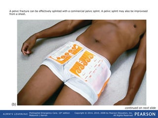Prehospital Emergency Care, 10th
edition
Mistovich | Karren
Copyright © 2014, 2010, 2008 by Pearson Education, Inc.
All Rights Reserved
A pelvic fracture can be effectively splinted with a commercial pelvic splint. A pelvic splint may also be improvised
from a sheet.
continued on next slide
 