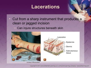Soft Tissue Trauma for Pre-Hospital Provider | PPT