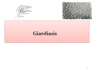 33
Giardiasis
 