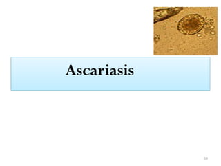59
Ascariasis
 