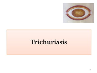 68
Trichuriasis
 