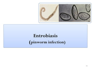 74
Entrobiasis
(pinworm infection)
 