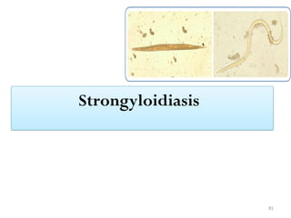 81
Strongyloidiasis
 