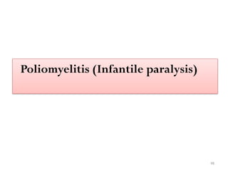 98
Poliomyelitis (Infantile paralysis)
 