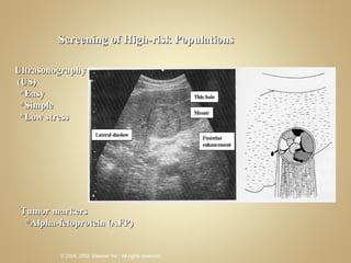 Screening of High-risk Populations Tumor markers *Alpha-fetoprotein (AFP) Ultrasonography (US) *Easy *Simple *Low stress 