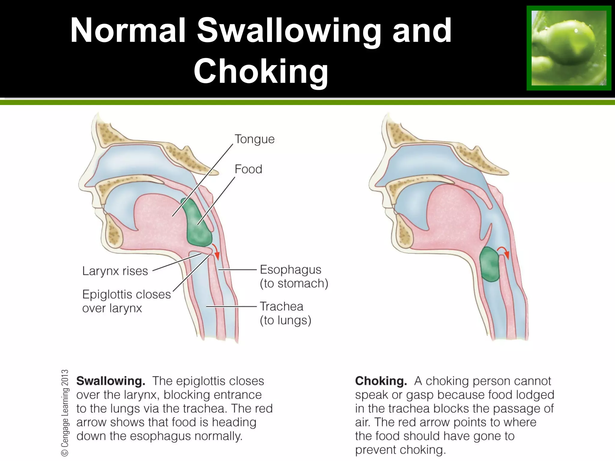 Normal Swallowing andNormal Swallowing and
ChokingChoking
 