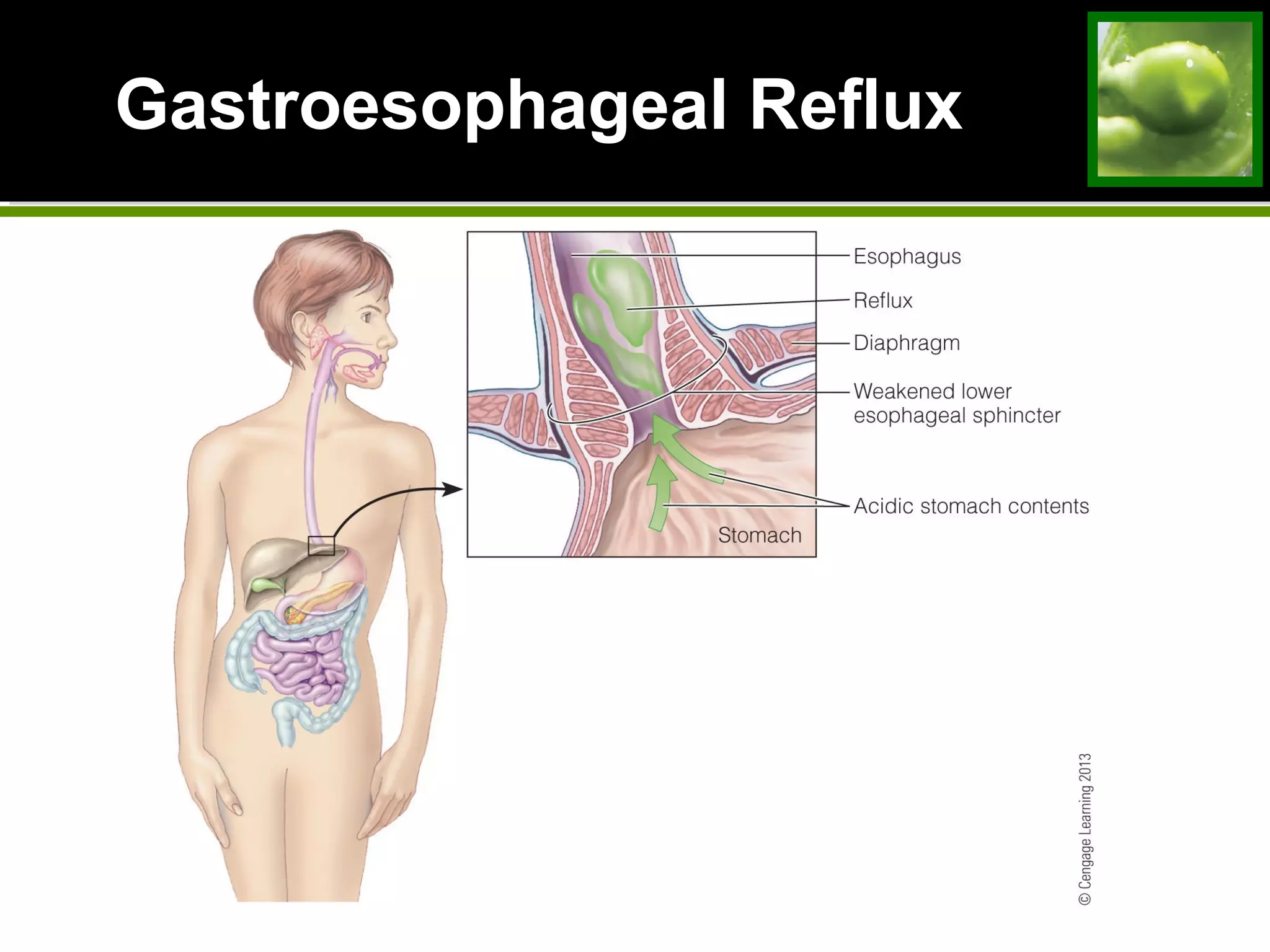 Gastroesophageal Reflux
 