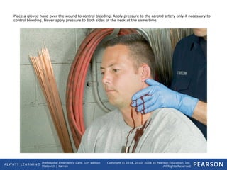 Prehospital Emergency Care, 10th
edition
Mistovich | Karren
Copyright © 2014, 2010, 2008 by Pearson Education, Inc.
All Rights Reserved
Place a gloved hand over the wound to control bleeding. Apply pressure to the carotid artery only if necessary to
control bleeding. Never apply pressure to both sides of the neck at the same time.
 