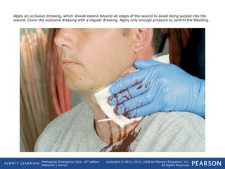 Prehospital Emergency Care, 10th
edition
Mistovich | Karren
Copyright © 2014, 2010, 2008 by Pearson Education, Inc.
All Rights Reserved
Apply an occlusive dressing, which should extend beyond all edges of the wound to avoid being sucked into the
wound. Cover the occlusive dressing with a regular dressing. Apply only enough pressure to control the bleeding.
 