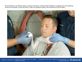 Prehospital Emergency Care, 10th
edition
Mistovich | Karren
Copyright © 2014, 2010, 2008 by Pearson Education, Inc.
All Rights Reserved
Once bleeding is controlled, apply a pressure dressing. A figure-eight bandage is wrapped over the dressing,
across one shoulder, across the back, under the opposite armpit, and anchored at the shoulder.
 