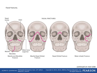 Prehospital Emergency Care, 10th
edition
Mistovich | Karren
Copyright © 2014, 2010, 2008 by Pearson Education, Inc.
All Rights Reserved
Facial fractures.
continued on next slide
 