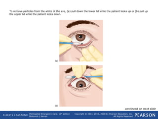 Prehospital Emergency Care, 10th
edition
Mistovich | Karren
Copyright © 2014, 2010, 2008 by Pearson Education, Inc.
All Rights Reserved
To remove particles from the white of the eye, (a) pull down the lower lid while the patient looks up or (b) pull up
the upper lid while the patient looks down.
continued on next slide
 