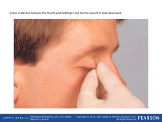 Prehospital Emergency Care, 10th
edition
Mistovich | Karren
Copyright © 2014, 2010, 2008 by Pearson Education, Inc.
All Rights Reserved
Grasp eyelashes between the thumb and forefinger and tell the patient to look downward.
 
