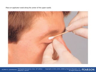 Prehospital Emergency Care, 10th
edition
Mistovich | Karren
Copyright © 2014, 2010, 2008 by Pearson Education, Inc.
All Rights Reserved
Place an applicator swab along the center of the upper eyelid.
 