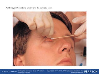 Prehospital Emergency Care, 10th
edition
Mistovich | Karren
Copyright © 2014, 2010, 2008 by Pearson Education, Inc.
All Rights Reserved
Pull the eyelid forward and upward over the applicator swab.
 