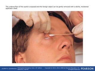 Prehospital Emergency Care, 10th
edition
Mistovich | Karren
Copyright © 2014, 2010, 2008 by Pearson Education, Inc.
All Rights Reserved
The undersurface of the eyelid is exposed and the foreign object can be gently removed with a sterile, moistened
applicator swab.
 