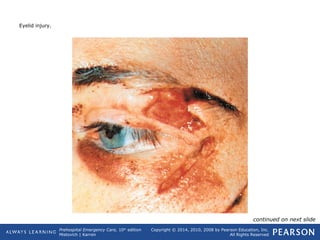Prehospital Emergency Care, 10th
edition
Mistovich | Karren
Copyright © 2014, 2010, 2008 by Pearson Education, Inc.
All Rights Reserved
Eyelid injury.
continued on next slide
 