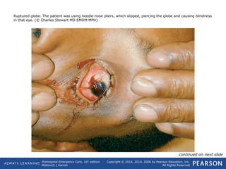 Prehospital Emergency Care, 10th
edition
Mistovich | Karren
Copyright © 2014, 2010, 2008 by Pearson Education, Inc.
All Rights Reserved
Ruptured globe. The patient was using needle-nose pliers, which slipped, piercing the globe and causing blindness
in that eye. (© Charles Stewart MD EMDM MPH)
continued on next slide
 