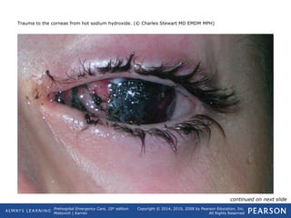 Prehospital Emergency Care, 10th
edition
Mistovich | Karren
Copyright © 2014, 2010, 2008 by Pearson Education, Inc.
All Rights Reserved
Trauma to the corneas from hot sodium hydroxide. (© Charles Stewart MD EMDM MPH)
continued on next slide
 