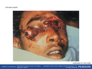 Prehospital Emergency Care, 10th
edition
Mistovich | Karren
Copyright © 2014, 2010, 2008 by Pearson Education, Inc.
All Rights Reserved
Extruded eyeball.
continued on next slide
 