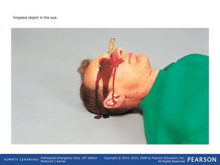 Prehospital Emergency Care, 10th
edition
Mistovich | Karren
Copyright © 2014, 2010, 2008 by Pearson Education, Inc.
All Rights Reserved
Impaled object in the eye.
 