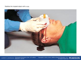 Prehospital Emergency Care, 10th
edition
Mistovich | Karren
Copyright © 2014, 2010, 2008 by Pearson Education, Inc.
All Rights Reserved
Stabilize the impaled object with a cup.
 