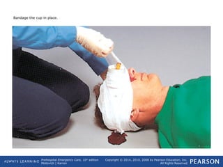 Prehospital Emergency Care, 10th
edition
Mistovich | Karren
Copyright © 2014, 2010, 2008 by Pearson Education, Inc.
All Rights Reserved
Bandage the cup in place.
 