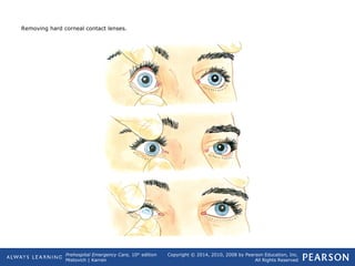 Prehospital Emergency Care, 10th
edition
Mistovich | Karren
Copyright © 2014, 2010, 2008 by Pearson Education, Inc.
All Rights Reserved
Removing hard corneal contact lenses.
 