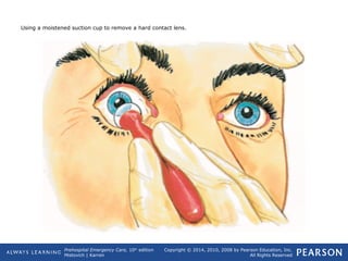 Prehospital Emergency Care, 10th
edition
Mistovich | Karren
Copyright © 2014, 2010, 2008 by Pearson Education, Inc.
All Rights Reserved
Using a moistened suction cup to remove a hard contact lens.
 
