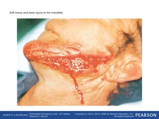 Prehospital Emergency Care, 10th
edition
Mistovich | Karren
Copyright © 2014, 2010, 2008 by Pearson Education, Inc.
All Rights Reserved
Soft tissue and bone injury to the mandible.
 
